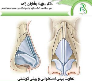 تفاوت بينی گوشتی و استخوانی چیست