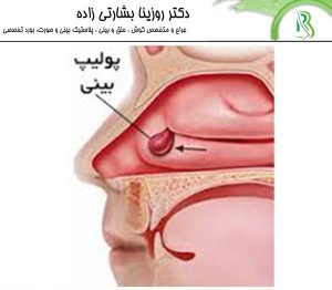 پولیپ بینی