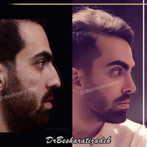 جراحی بینی استخوانی آقا