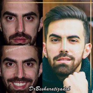 جراحی بینی استخوانی آقا - دکتر بشارتی زاده