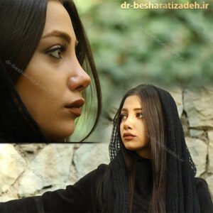 جراحی بینی استخوانی -دکتر روزینا بشارتی زاده