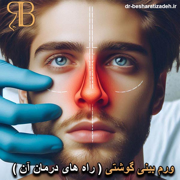 ورم بینی گوشتی - dr-besharatizadeh.ir