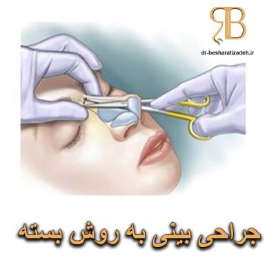 جراحی بینی به روش بسته - dr-besharatizadeh.ir