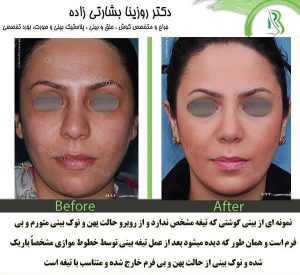 جراحی بینی گوشتی