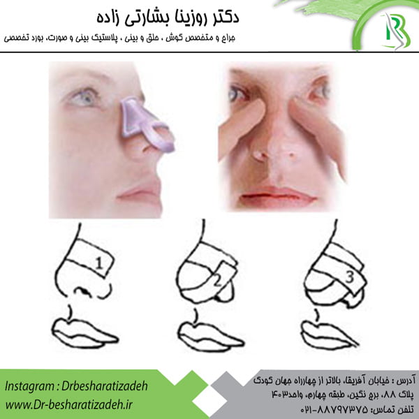 چسب توصیه شده پس از عمل بینی - دکتر روزینا بشارتی زاده