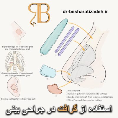 گرافت در جراحی بینی - dr-besharatizadeh.ir