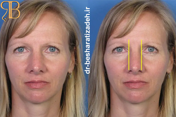استئوتومی در جراحی بینی - dr-besharatizadeh.ir