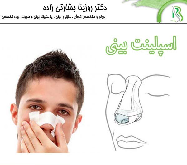 مزیت اسپلینت بینی بعد از جراحی با بهترین جراح بینی تهران