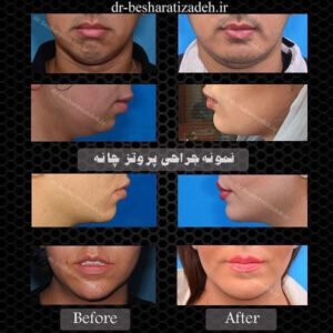 پروتز چانه - dr-besharatizadeh.ir