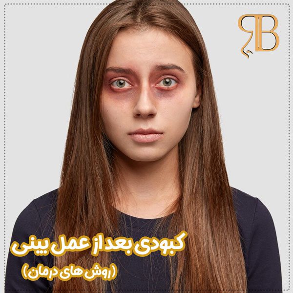 کبودی بعد از عمل بینی - دکتر بشارتی زاده