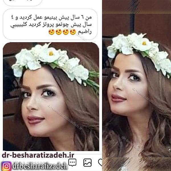 جراحی بینی 6