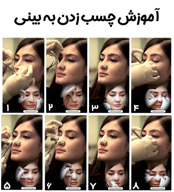آموزش چسب زدن بینی - دکتر روزینا بشارتی زاده