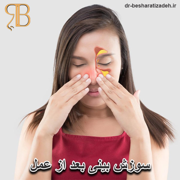 سوزش بعد از عمل بینی - dr-besharatizadeh.ir