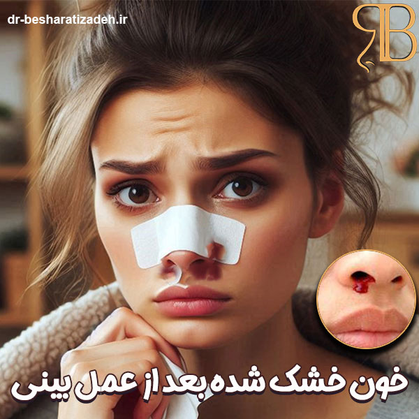 خون خشک شده در بینی بعد از عمل - dr-besharatizadeh.ir