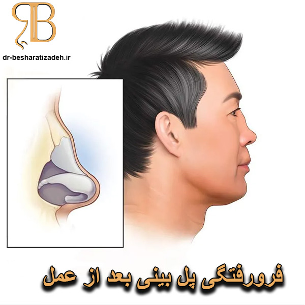 فرورفتگی پل بینی بعد از عمل بینی - dr-besharatizadeh.ir