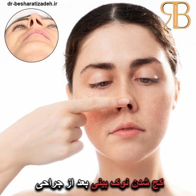 کج شدن نوک بینی بعد از جراحی - dr-besharatizadeh.ir