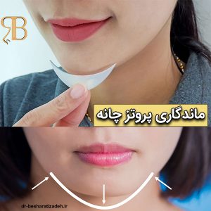 ماندگاری پروتز چانه - dr-besharatizadeh.ir 