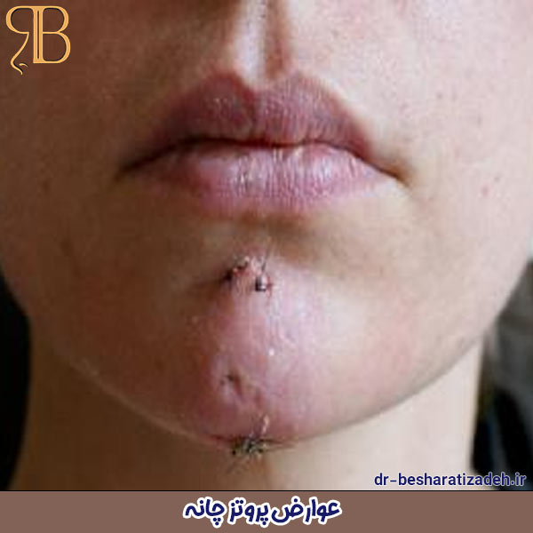 عوارض پروتز چانه