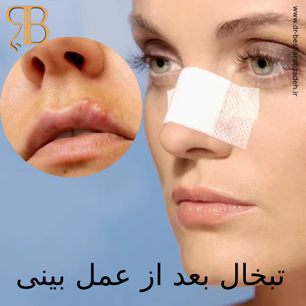 تبخال بعد از عمل بینی - دکتر روزینا بشارتی زاده