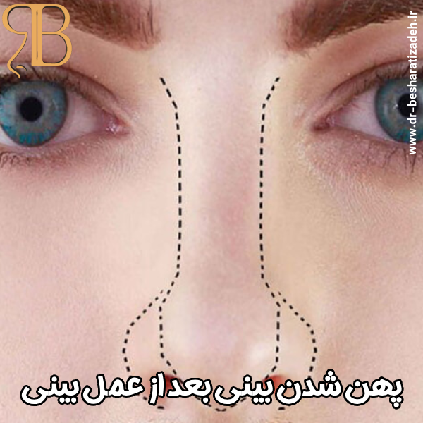 علت پهن شدن تیغه بینی بعد از عمل - دکتر روزینا بشارتی زاده
