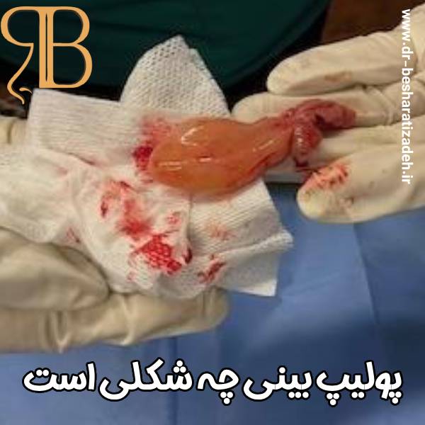 نشانه های پولیپ بینی با دکتر روزینا بشارتی زاده