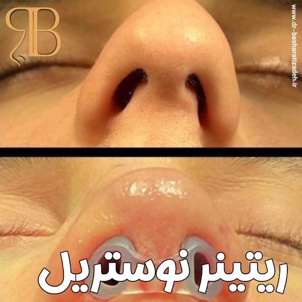 نوستریل ریتینر - دکتر روزینا بشارتی زاده